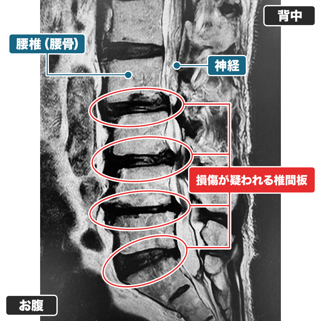 MRI検査