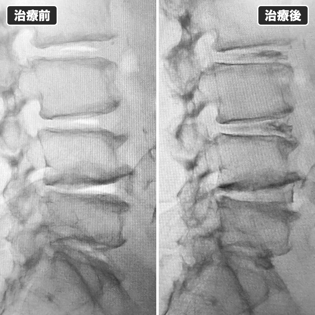 治療前後のレントゲン写真