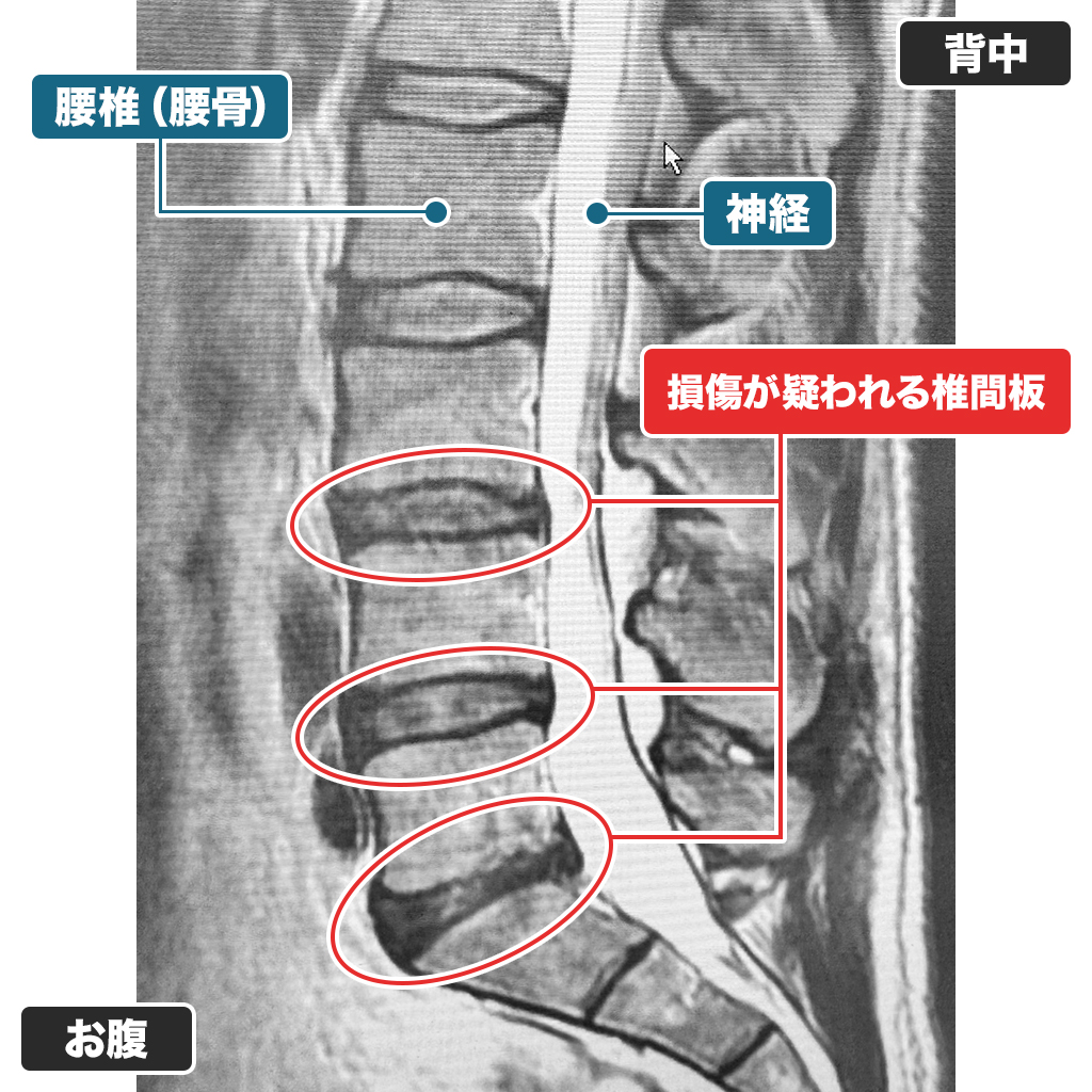 MRI検査