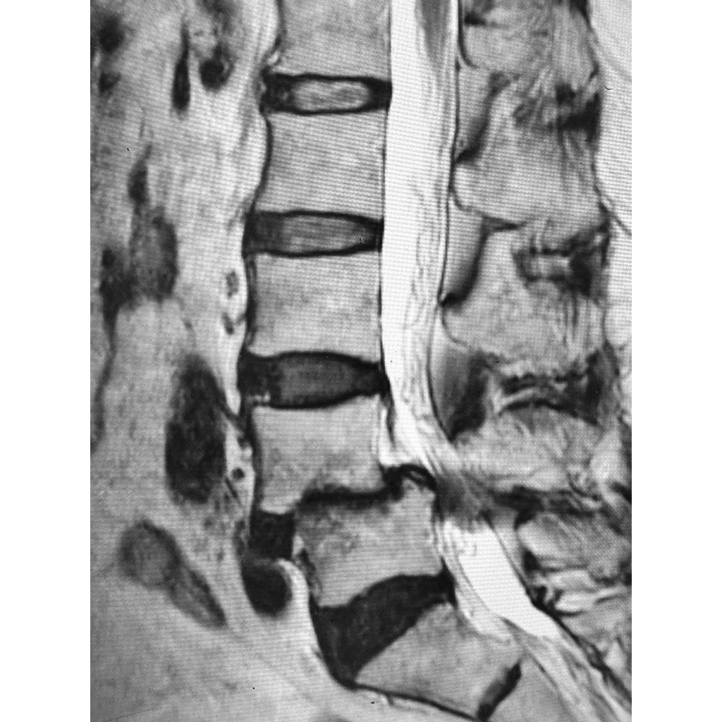 MRI:治療前