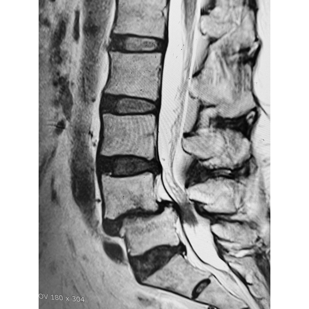 MRI:治療後