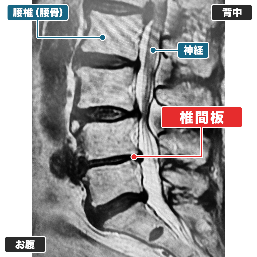 MRI検査