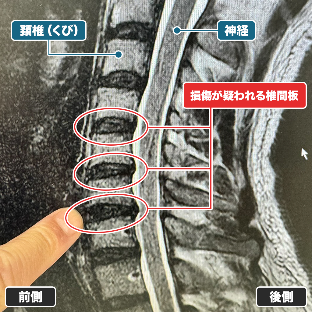 MRI検査