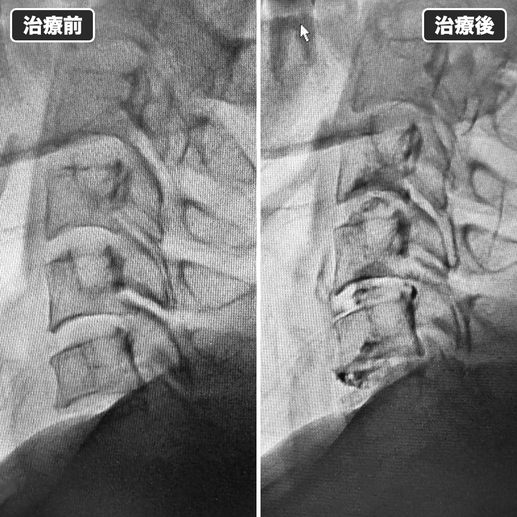 治療前後のレントゲン写真