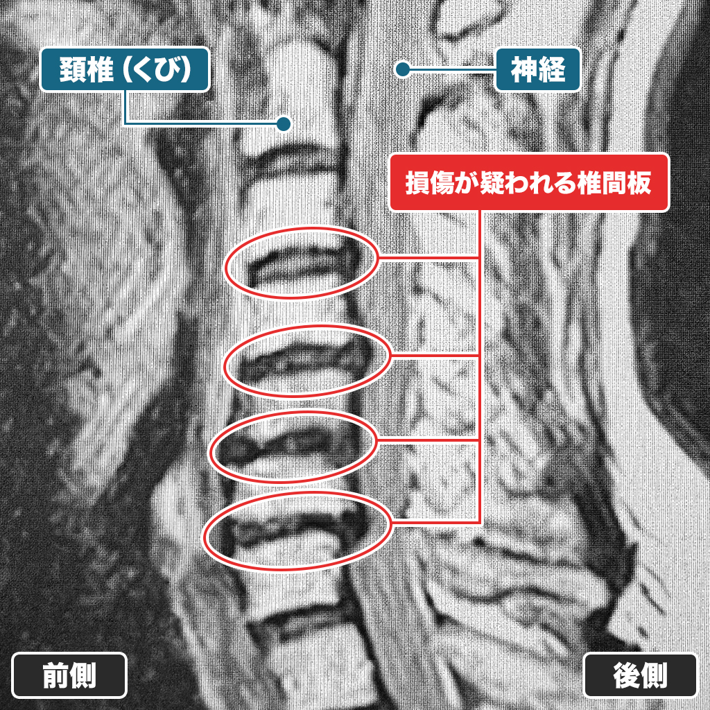 MRI検査