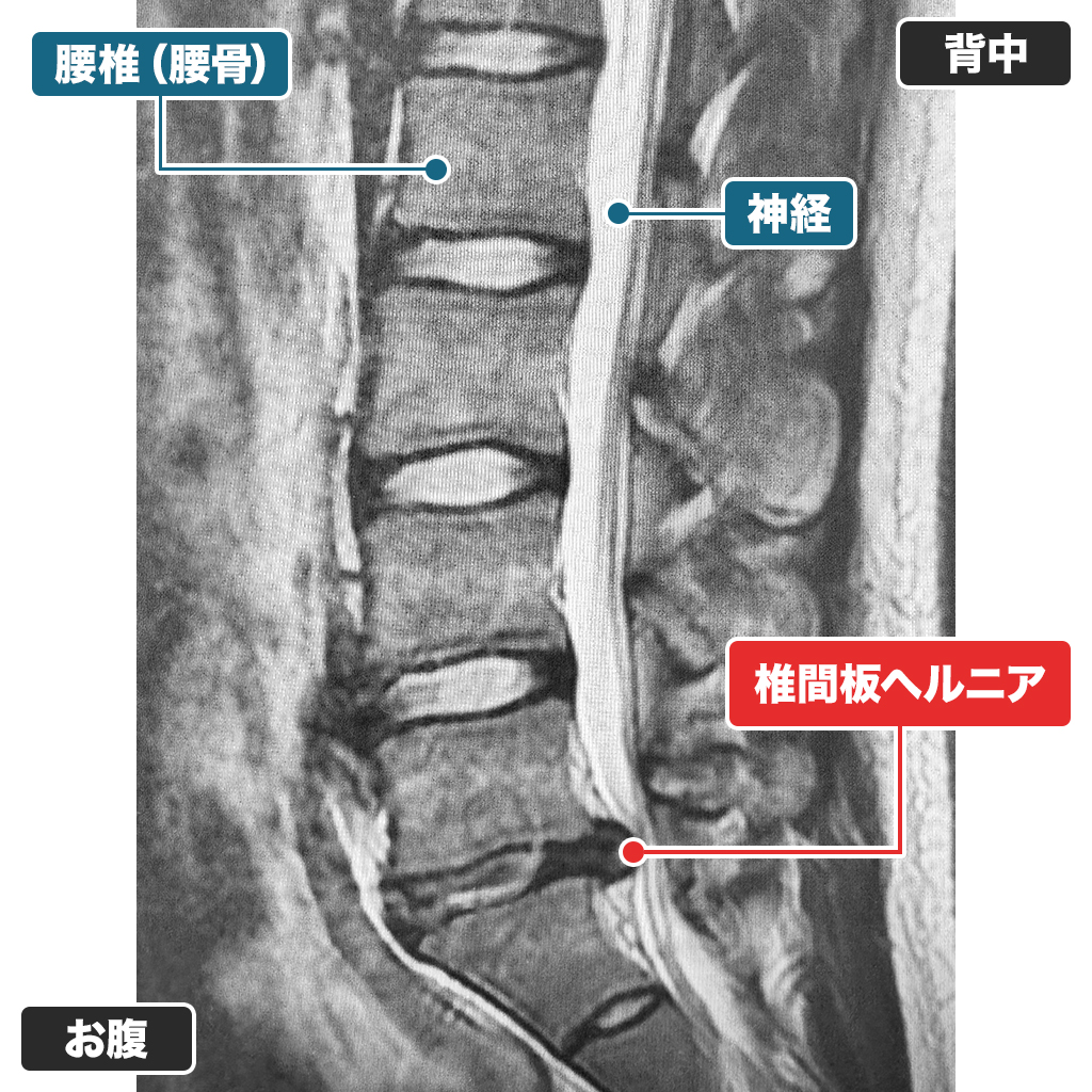 MRI検査