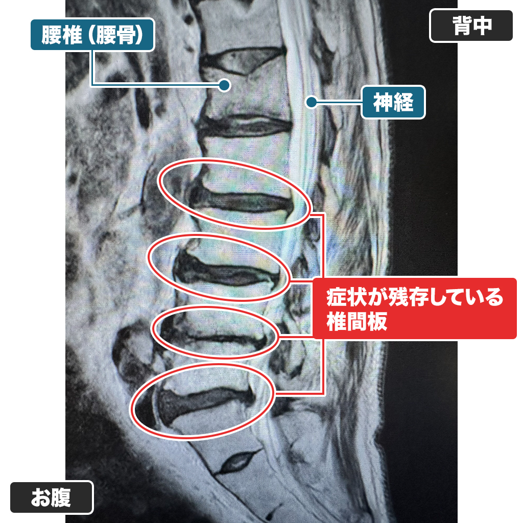 MRI検査