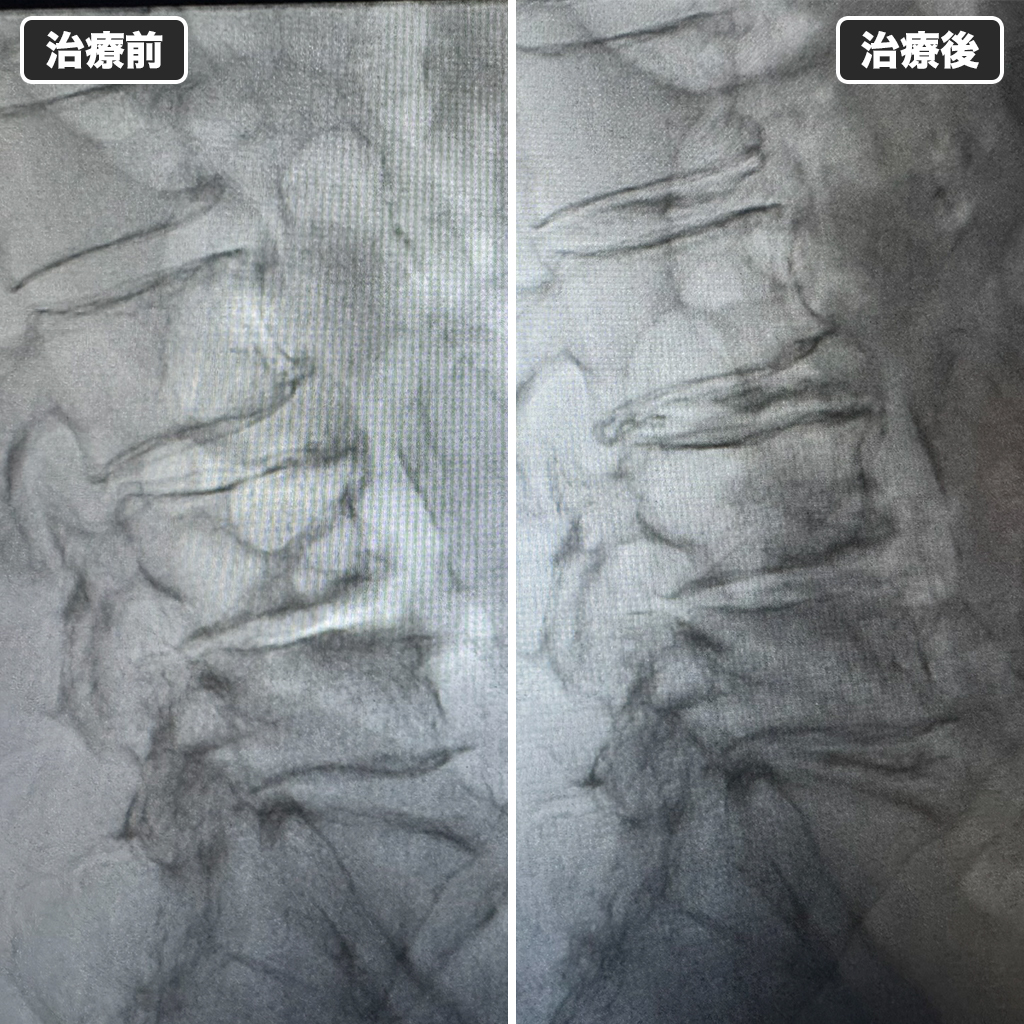 治療前後のレントゲン写真
