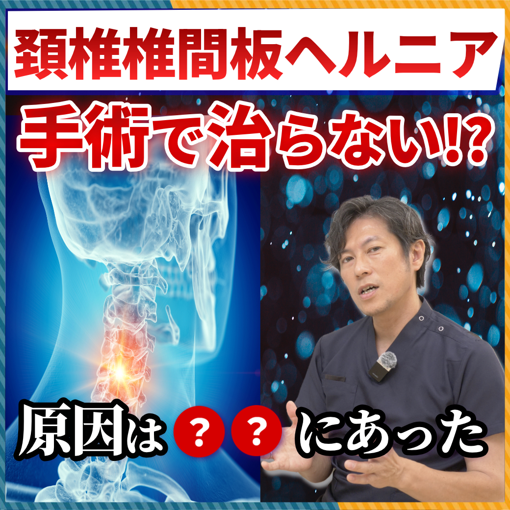 【医師解説】肩凝り・首の痛み・頭痛の原因は「頚椎椎間板ヘルニア」？最新の炎症メカニズムと切らない治療法（ディスクシール）とは