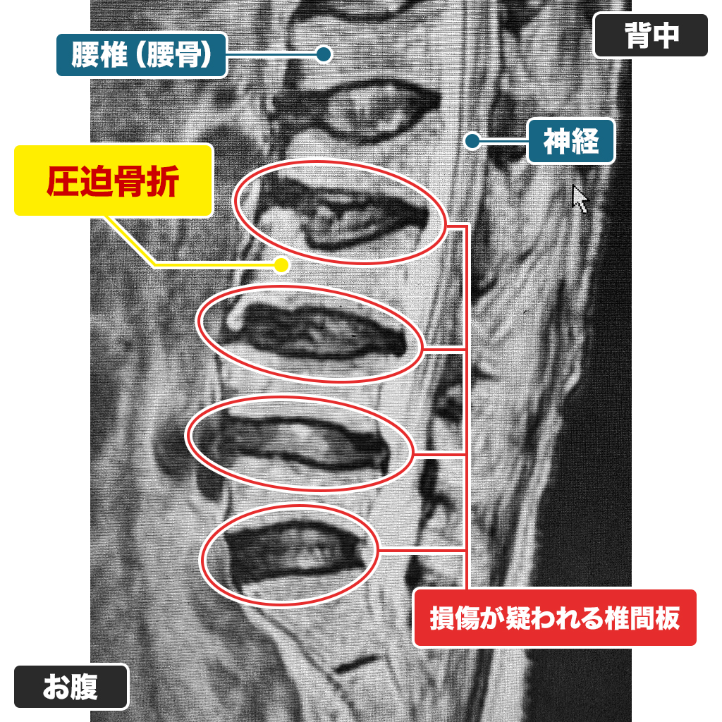 MRI検査