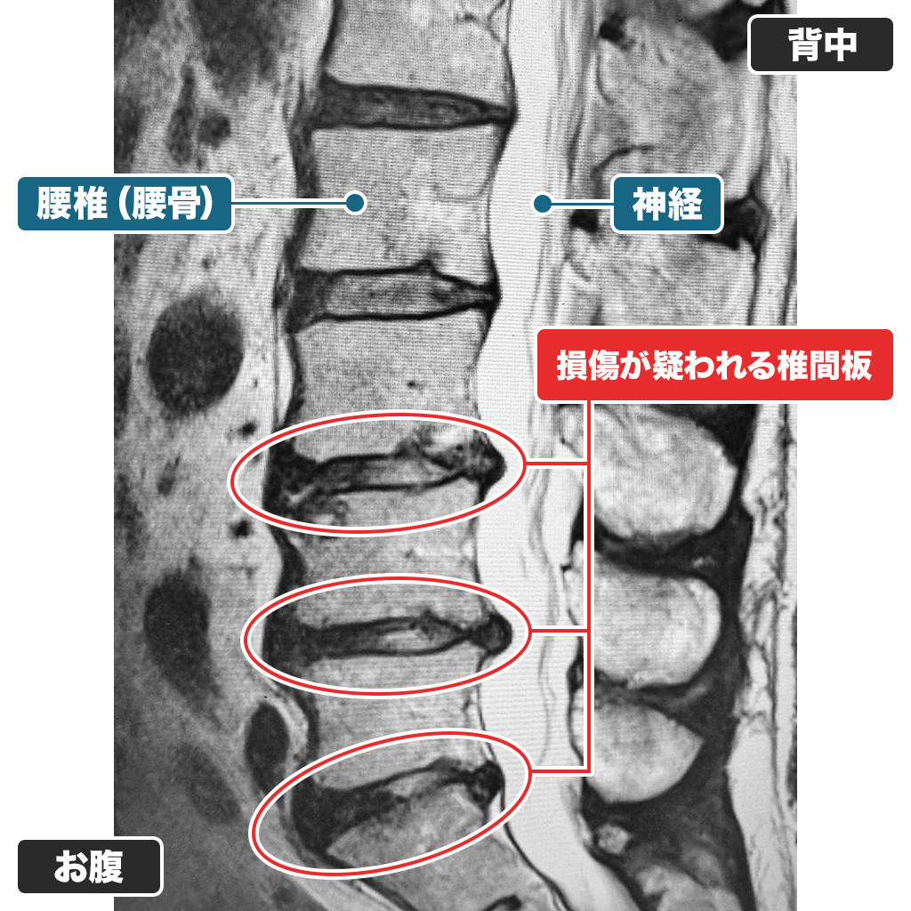 MRI検査