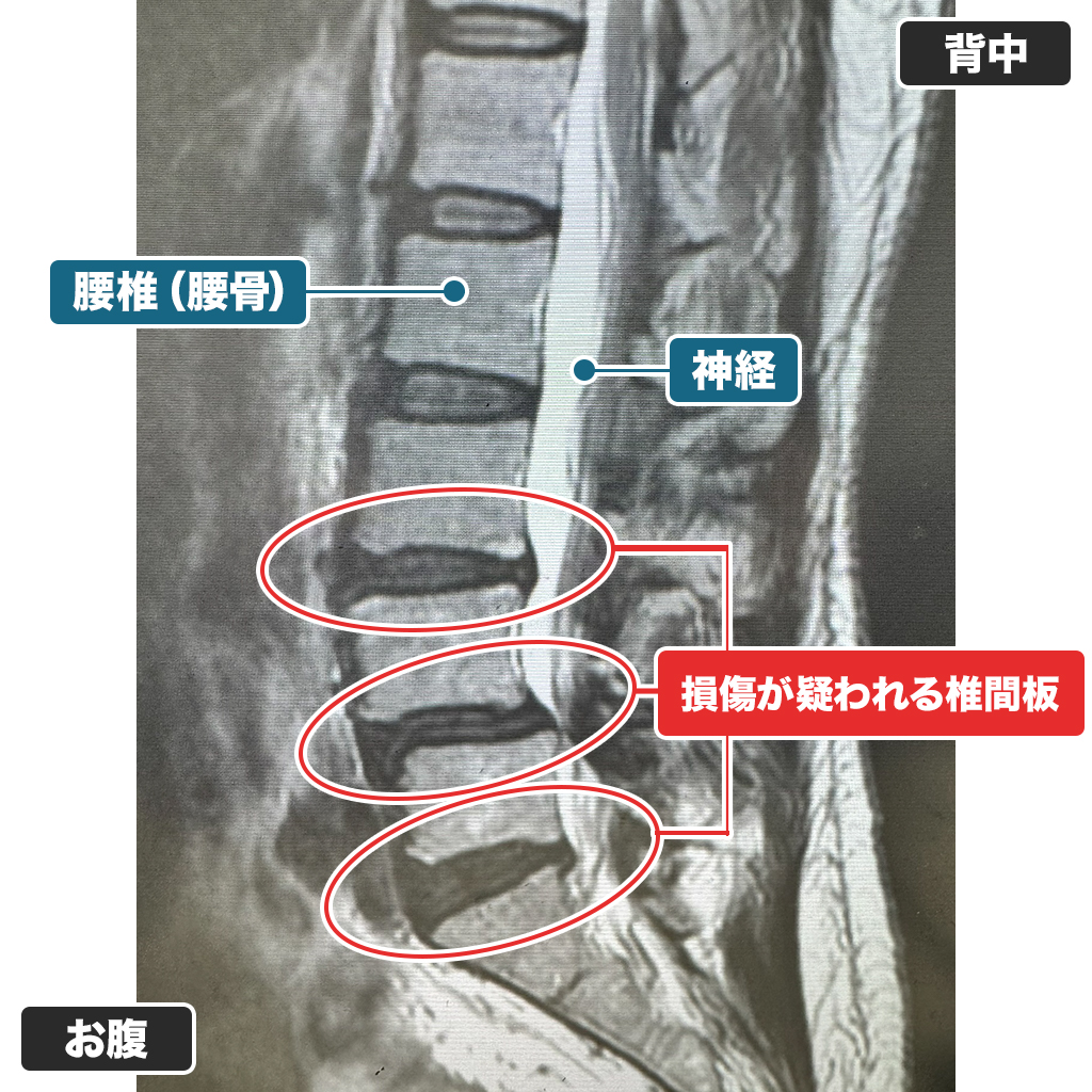 MRI検査
