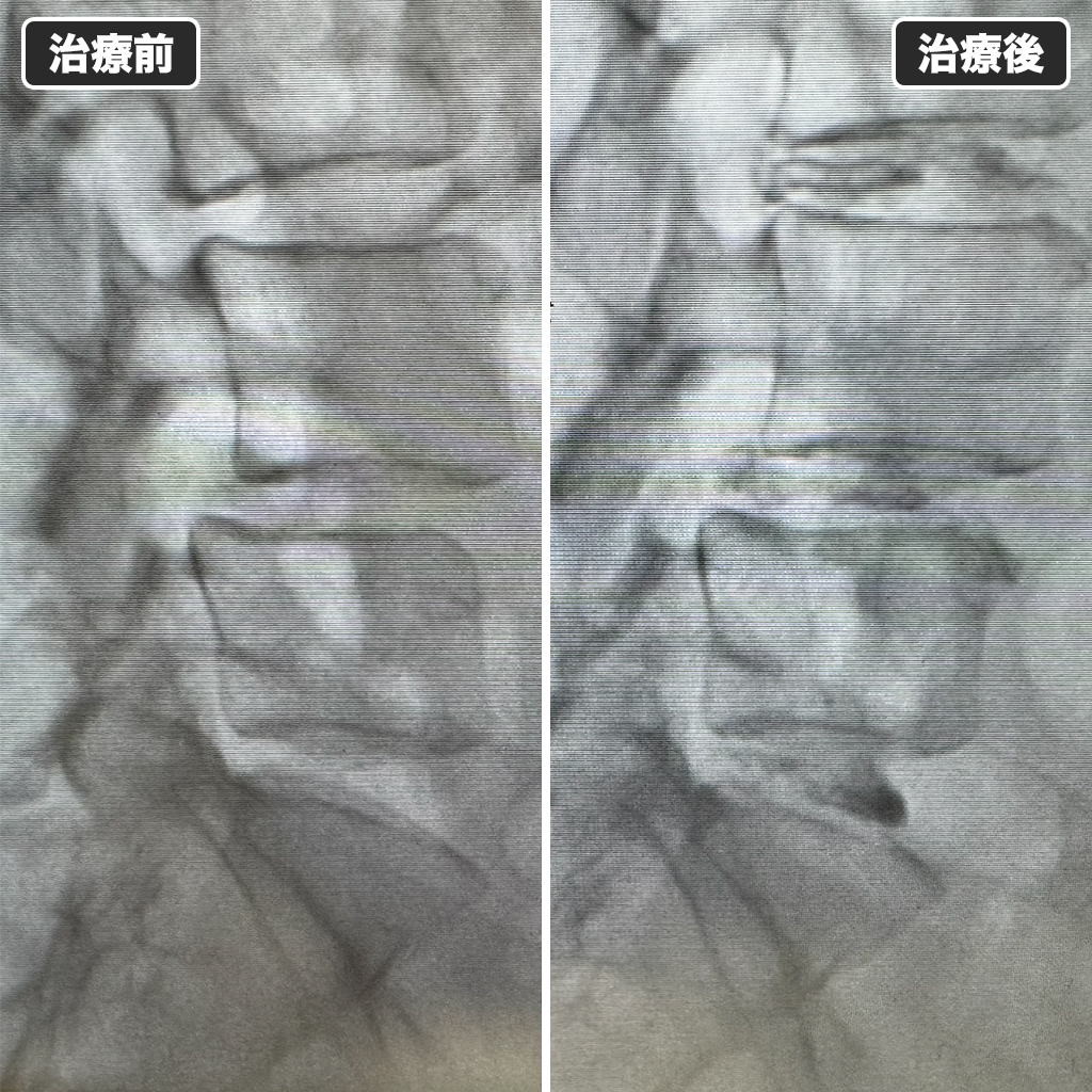治療前後のレントゲン写真