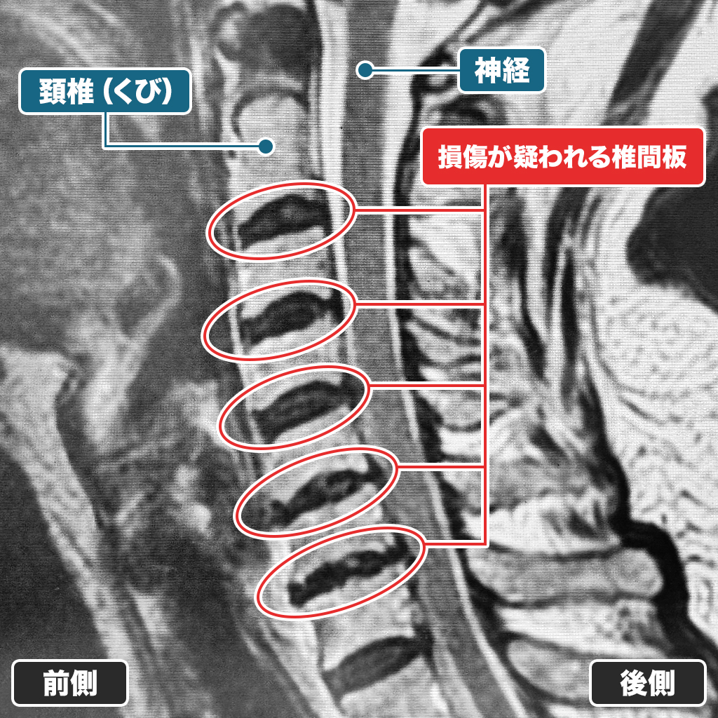 MRI検査