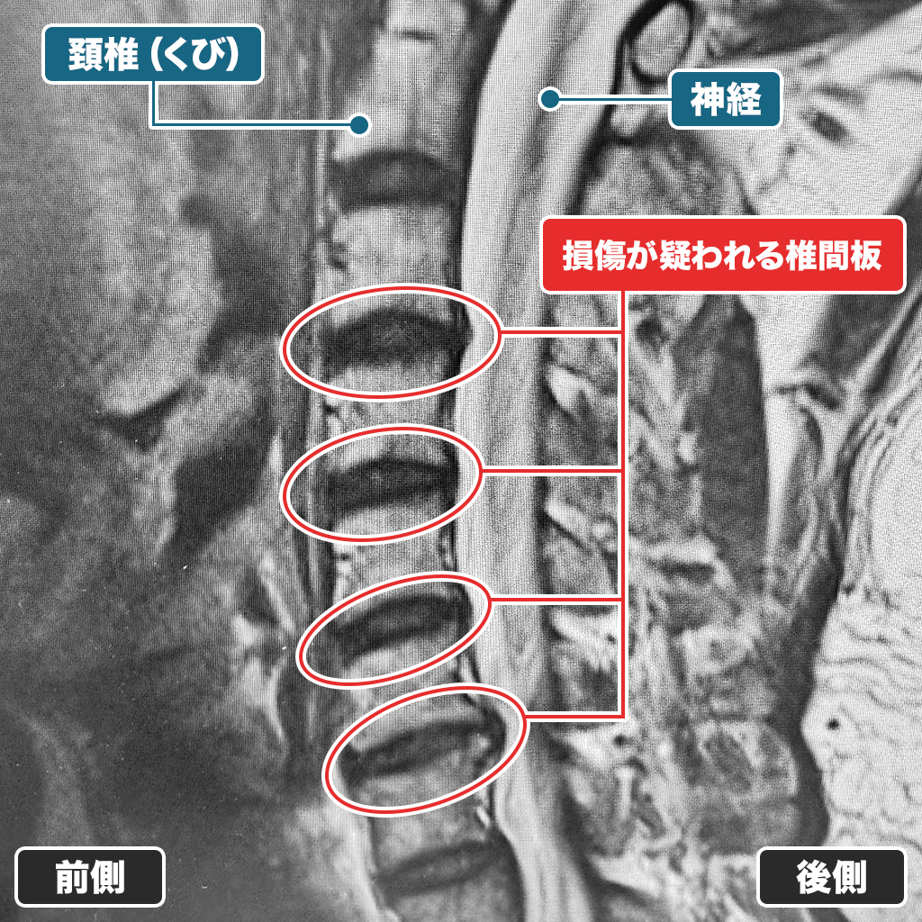 MRI検査