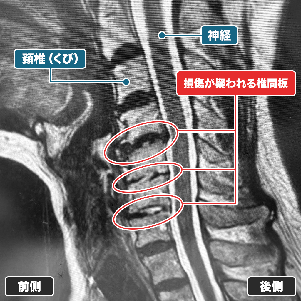 MRI検査
