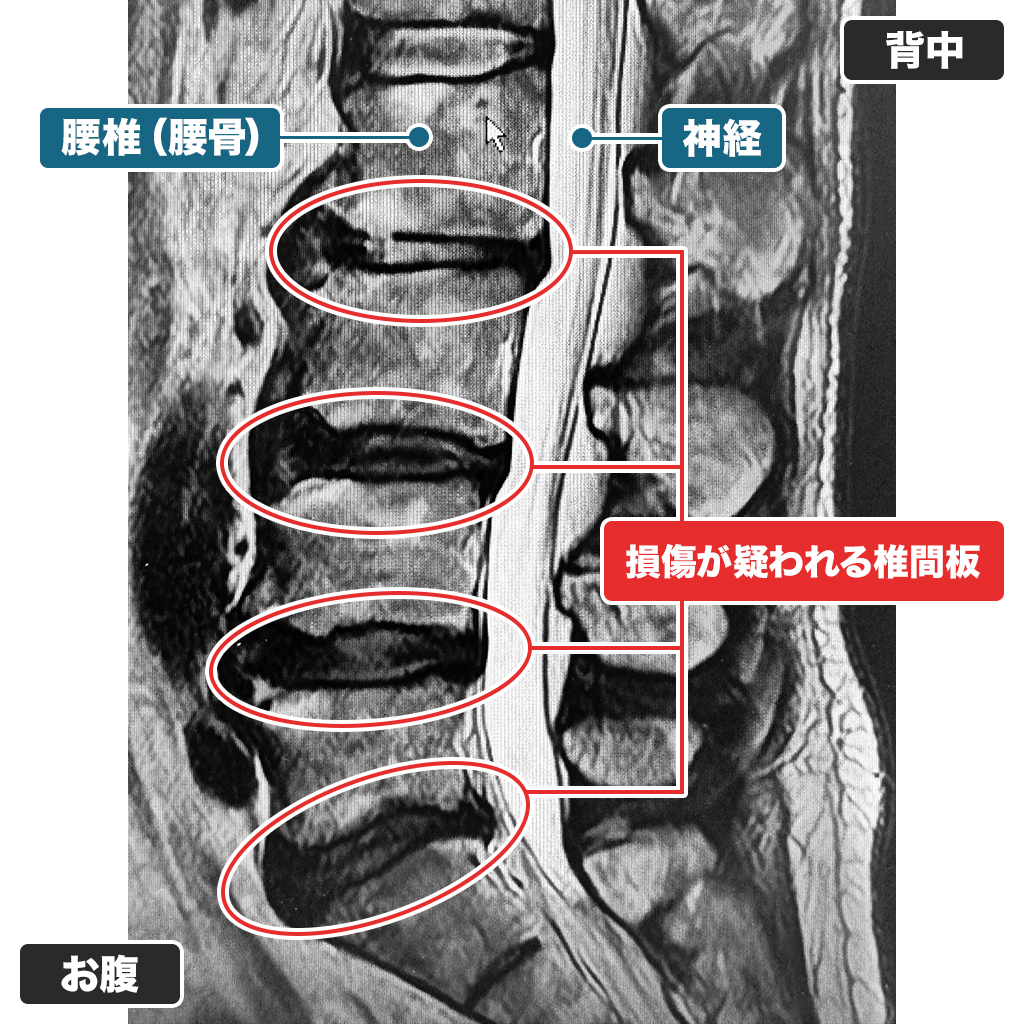 MRI検査