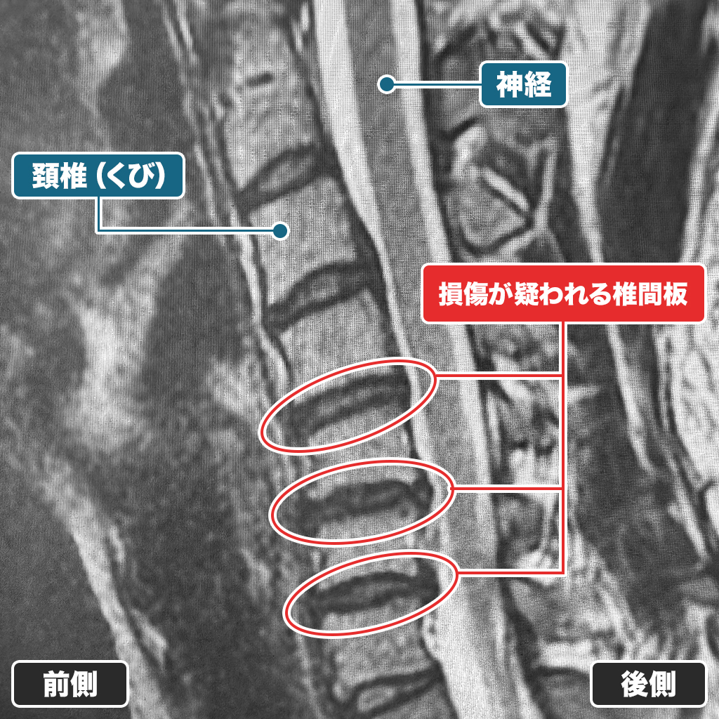 MRI検査