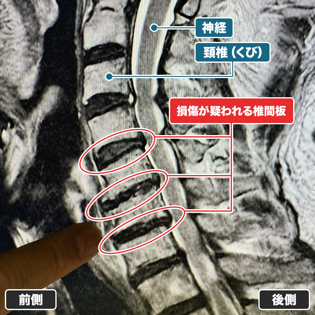 MRI検査