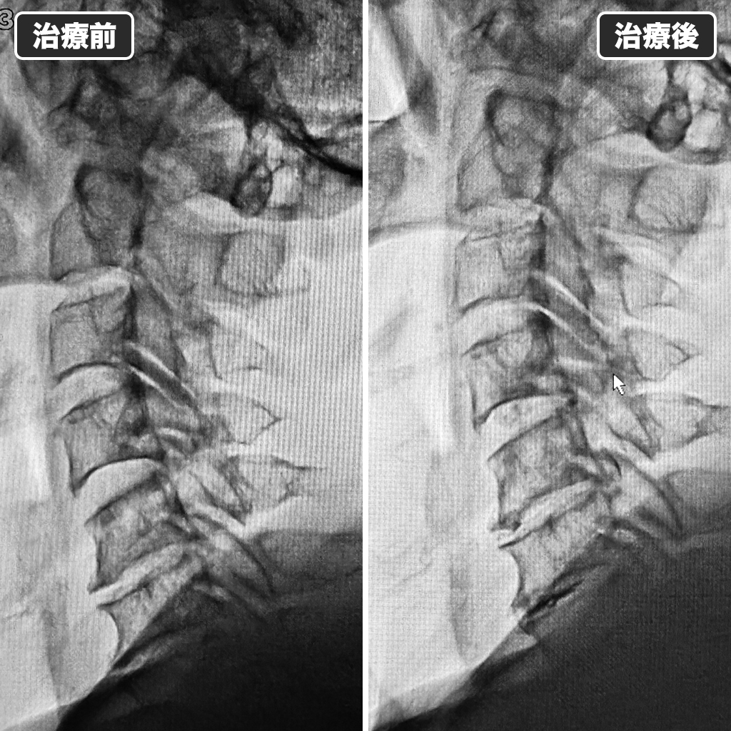 治療前後のレントゲン写真