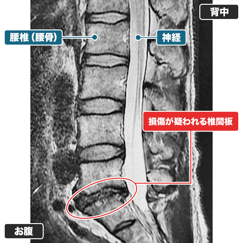 MRI検査