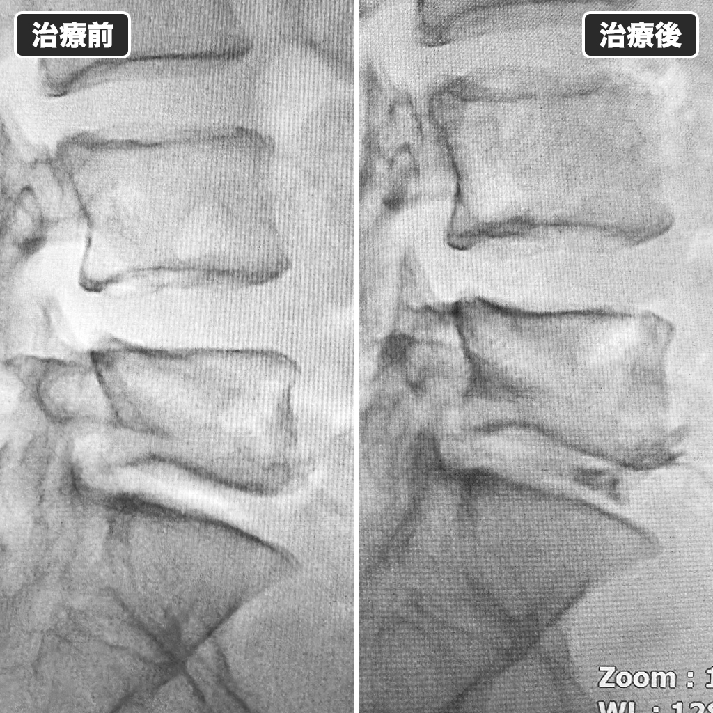 治療前後のレントゲン写真