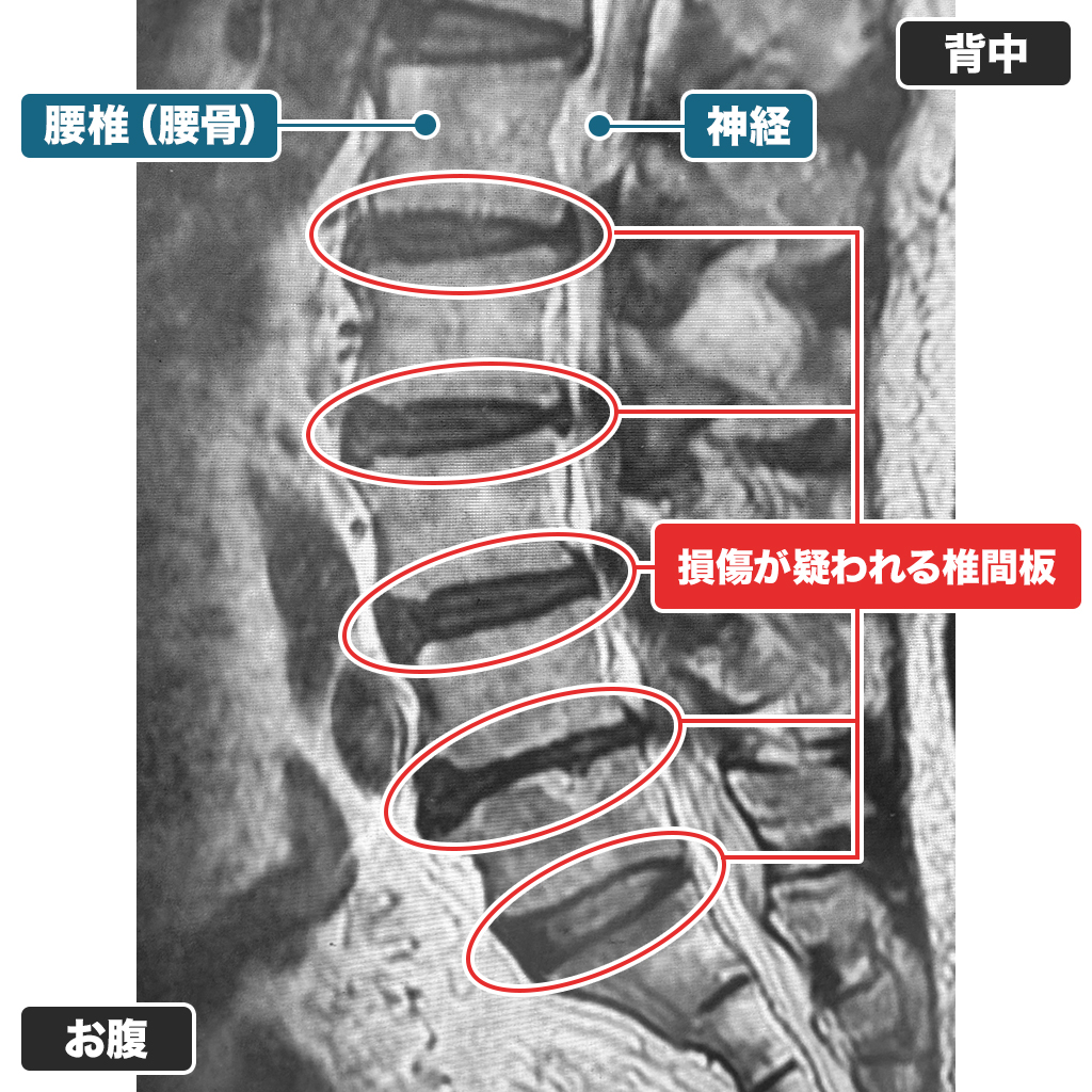MRI検査