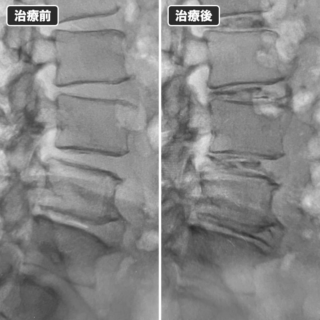 治療前後のレントゲン写真