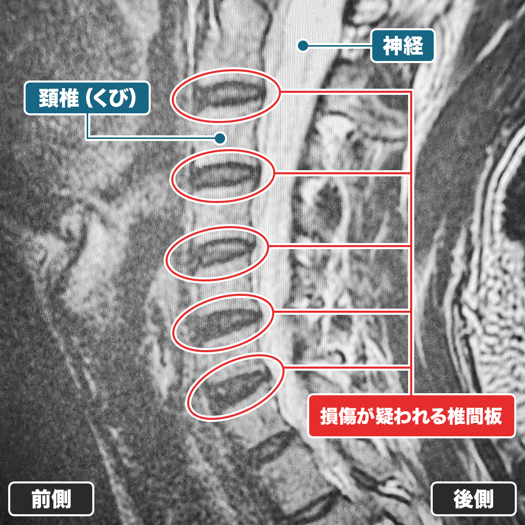 MRI検査