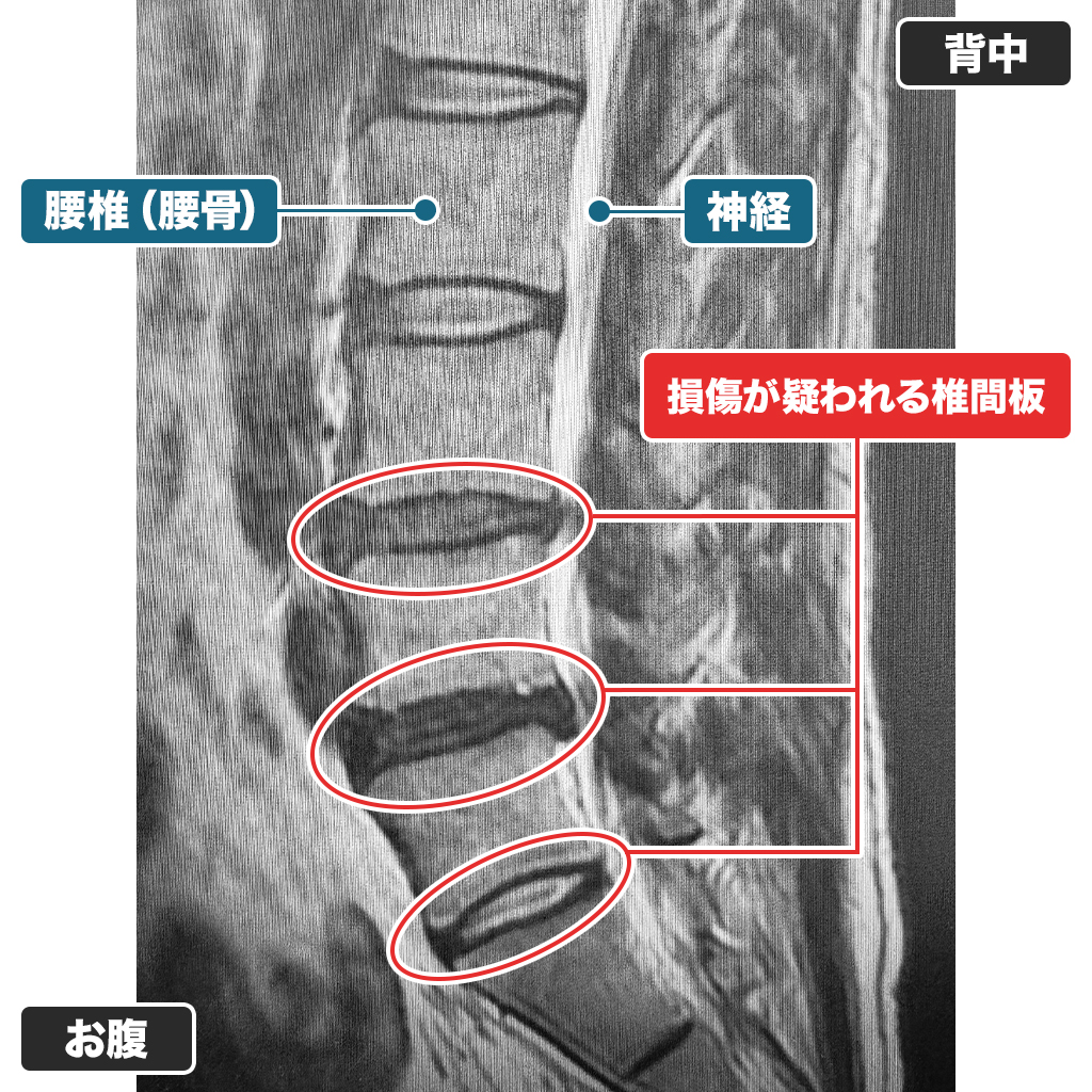 MRI検査