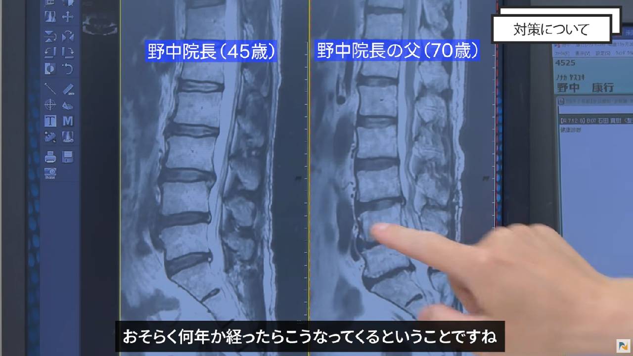 MRI画像