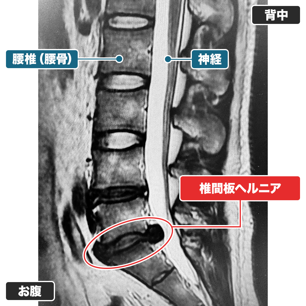 MRI検査