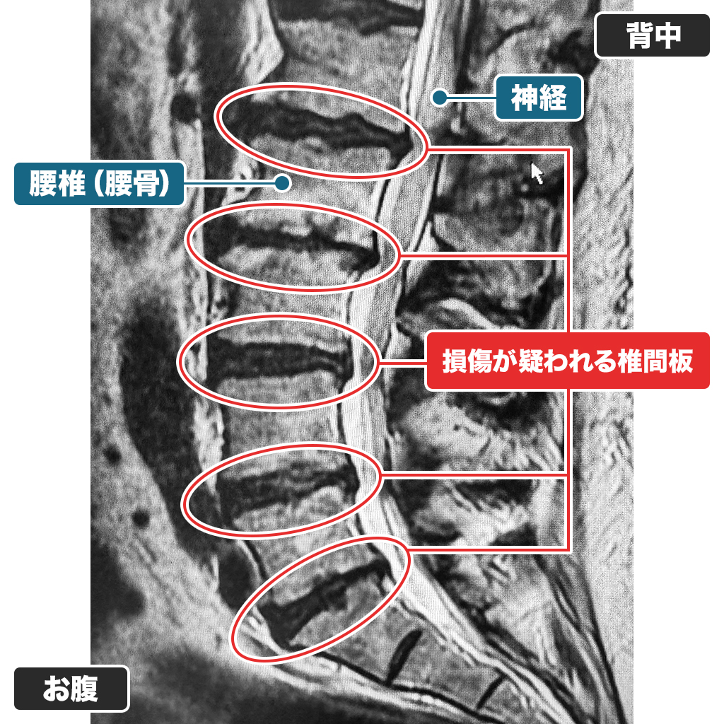 MRI検査