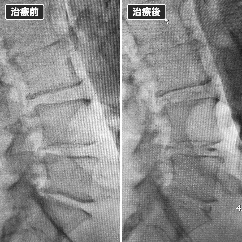 治療前後のレントゲン写真